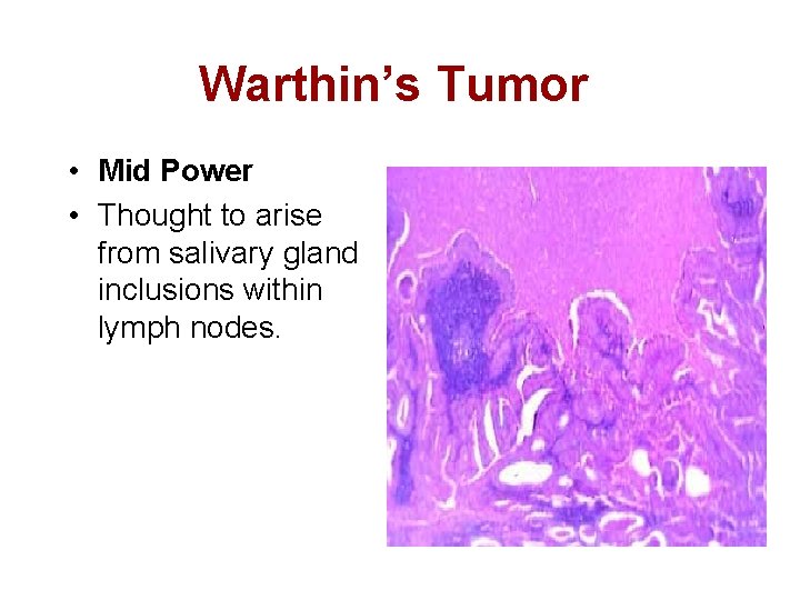 Warthin’s Tumor • Mid Power • Thought to arise from salivary gland inclusions within