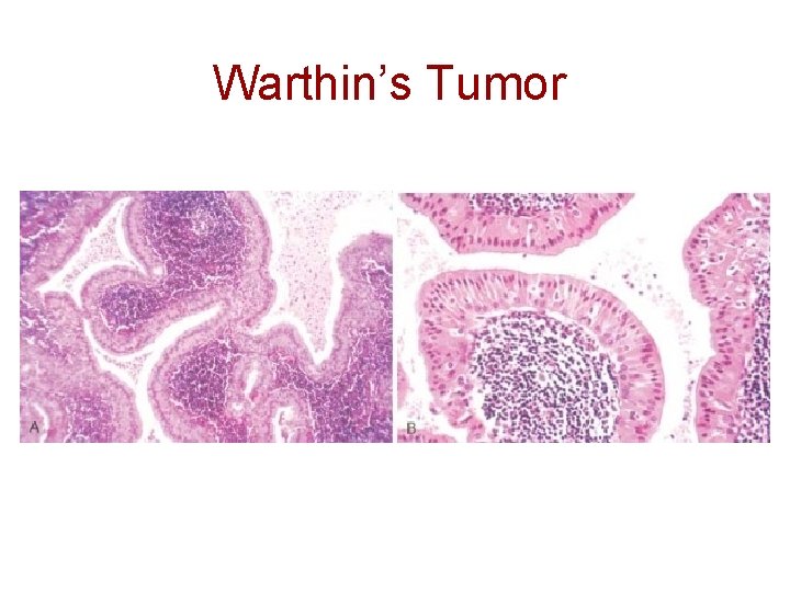 Warthin’s Tumor 