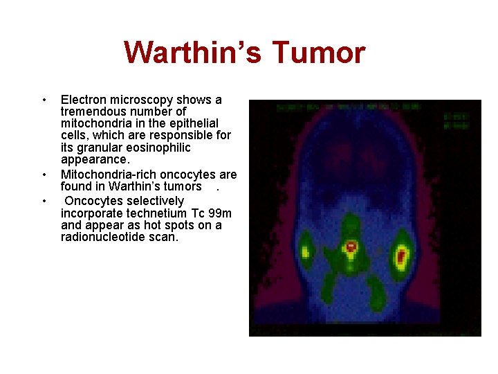 Warthin’s Tumor • • • Electron microscopy shows a tremendous number of mitochondria in