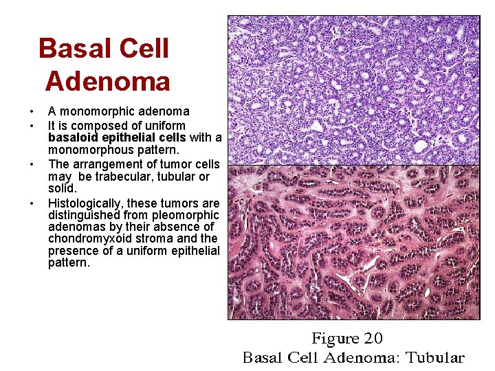 Basal Cell Adenoma • • A monomorphic adenoma It is composed of uniform basaloid