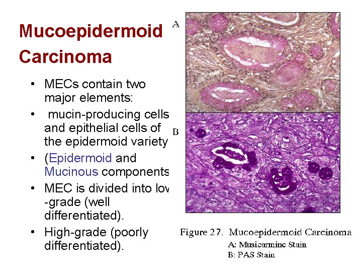 Mucoepidermoid Carcinoma • MECs contain two major elements: • mucin-producing cells and epithelial cells