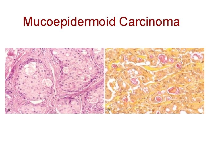 Mucoepidermoid Carcinoma 