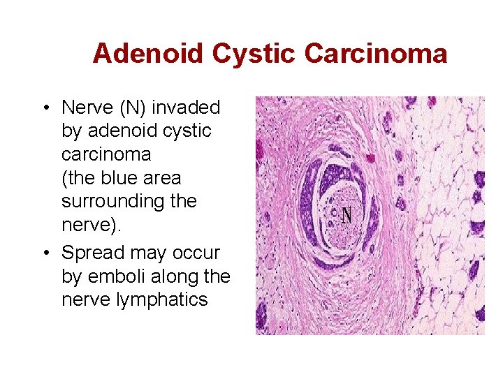 Adenoid Cystic Carcinoma • Nerve (N) invaded by adenoid cystic carcinoma (the blue area