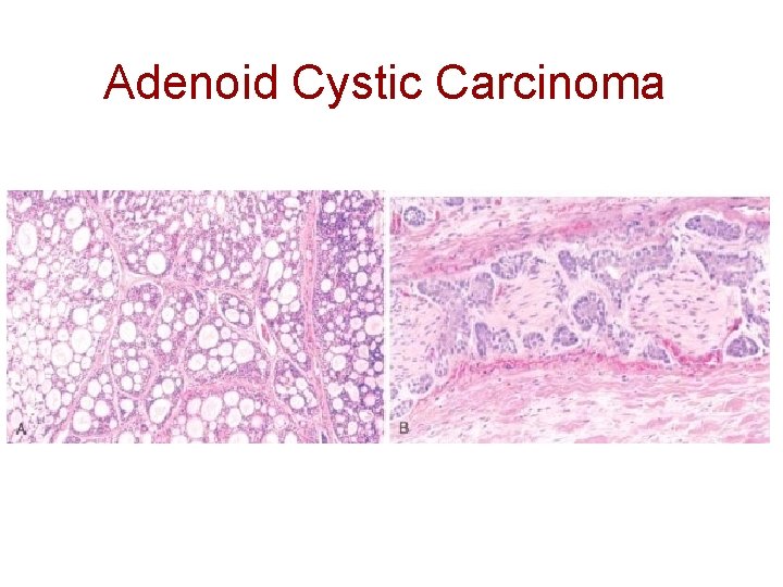 Adenoid Cystic Carcinoma 