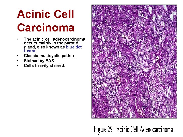 Acinic Cell Carcinoma • • The acinic cell adenocarcinoma occurs mainly in the parotid
