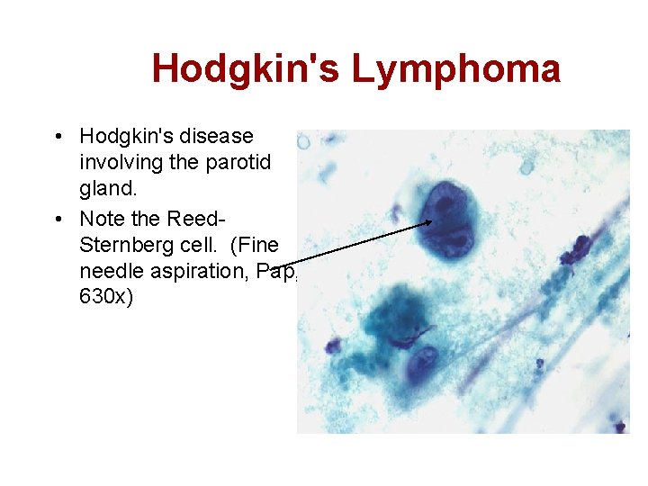 Hodgkin's Lymphoma • Hodgkin's disease involving the parotid gland. • Note the Reed. Sternberg