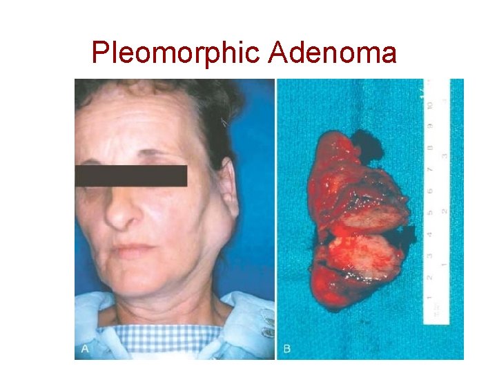 Pleomorphic Adenoma 