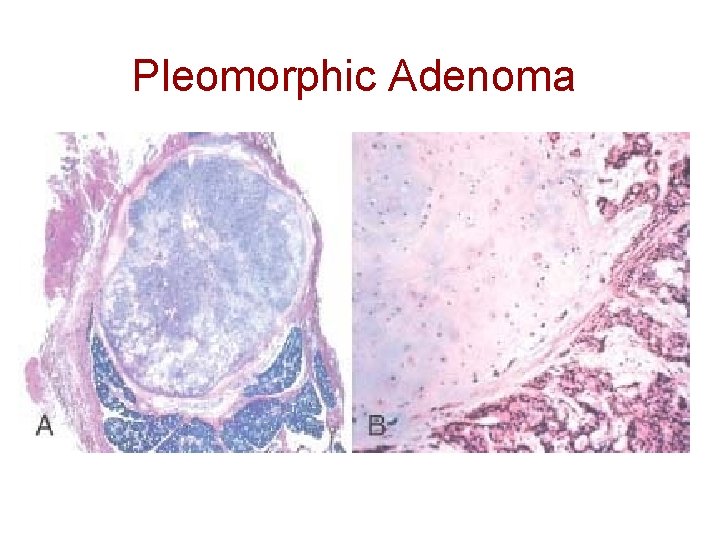 Pleomorphic Adenoma 