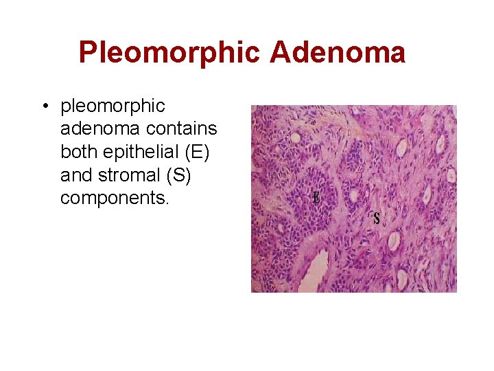 Pleomorphic Adenoma • pleomorphic adenoma contains both epithelial (E) and stromal (S) components. 