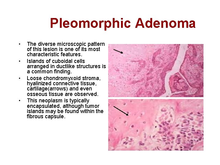  Pleomorphic Adenoma • • The diverse microscopic pattern of this lesion is one