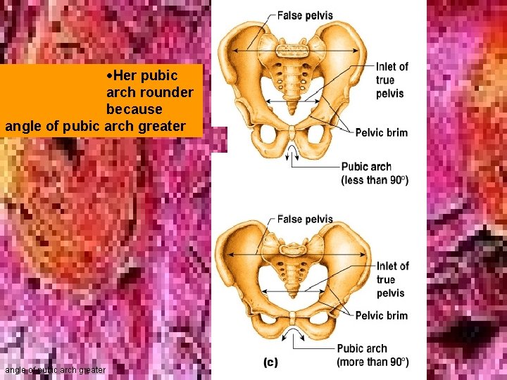 Her pubic arch rounder because angle of pubic arch greater Her pubic arch rounder because angle of pubic arch greater