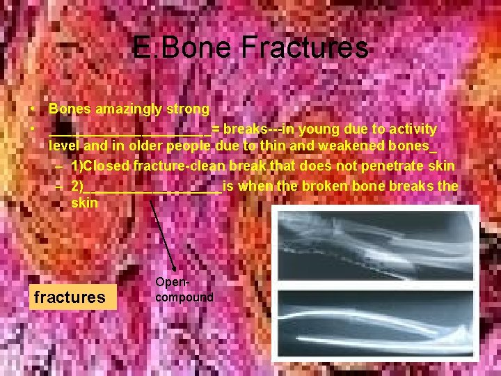 E. Bone Fractures • Bones amazingly strong • ___________= breaks---in young due to activity E. Bone Fractures • Bones amazingly strong • ___________= breaks---in young due to activity