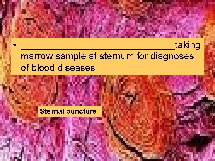 • _______________taking marrow sample at sternum for diagnoses of blood diseases Sternal puncture • _______________taking marrow sample at sternum for diagnoses of blood diseases Sternal puncture
