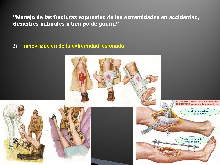 “Manejo de las fracturas expuestas de las extremidades en accidentes, desastres naturales o tiempo “Manejo de las fracturas expuestas de las extremidades en accidentes, desastres naturales o tiempo