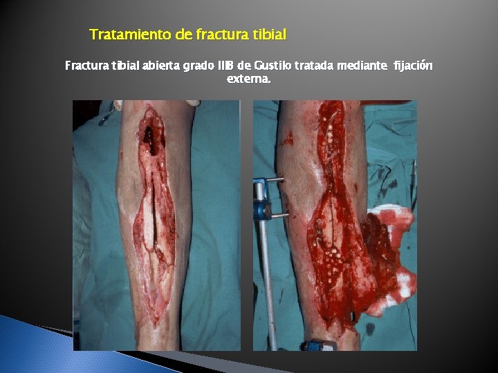 Tratamiento de fractura tibial Fractura tibial abierta grado IIIB de Gustilo tratada mediante fijación Tratamiento de fractura tibial Fractura tibial abierta grado IIIB de Gustilo tratada mediante fijación