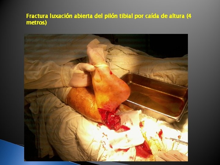 Fractura luxación abierta del pilón tibial por caída de altura (4 metros) Fractura luxación abierta del pilón tibial por caída de altura (4 metros)