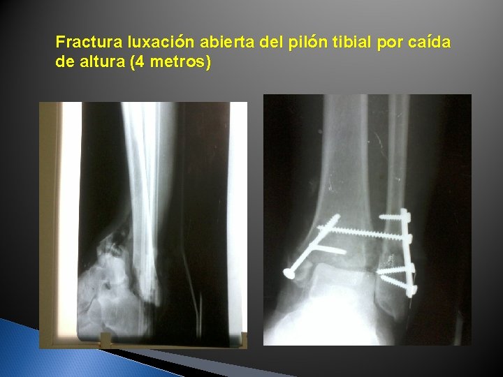 Fractura luxación abierta del pilón tibial por caída de altura (4 metros) Fractura luxación abierta del pilón tibial por caída de altura (4 metros)