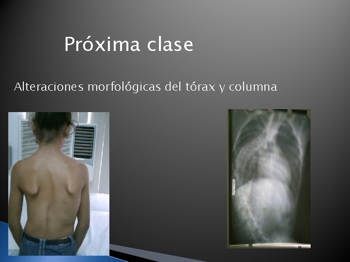 Próxima clase Alteraciones morfológicas del tórax y columna Próxima clase Alteraciones morfológicas del tórax y columna
