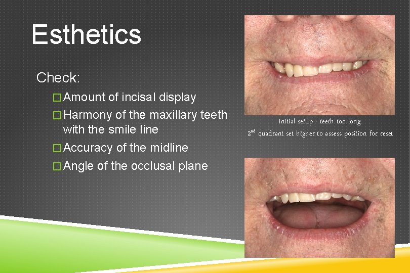 Esthetics Check: �Amount of incisal display �Harmony of the maxillary teeth with the smile