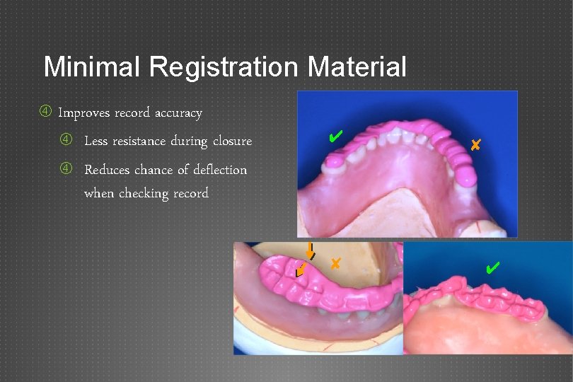 Minimal Registration Material Improves record accuracy Less resistance during closure ✔ ✘ Reduces chance