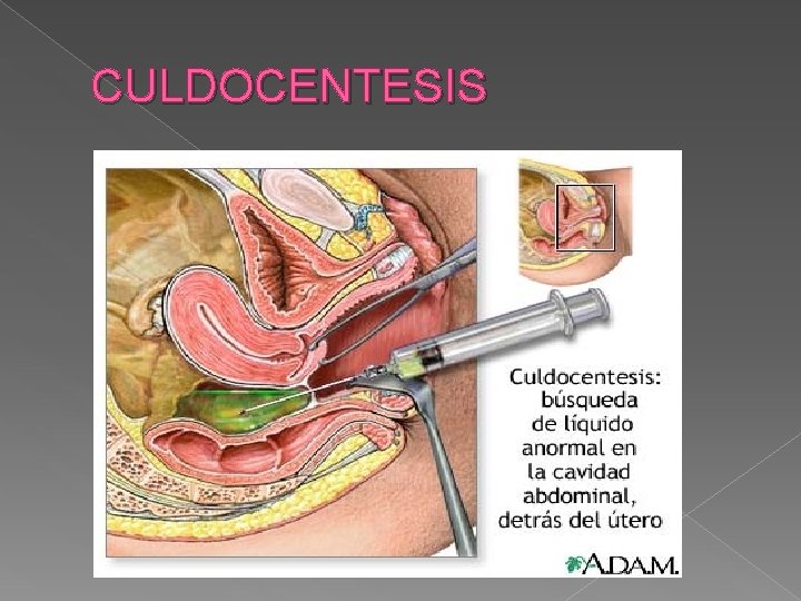 CULDOCENTESIS 