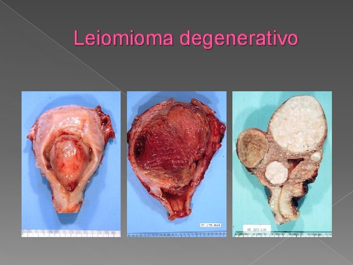 Leiomioma degenerativo 