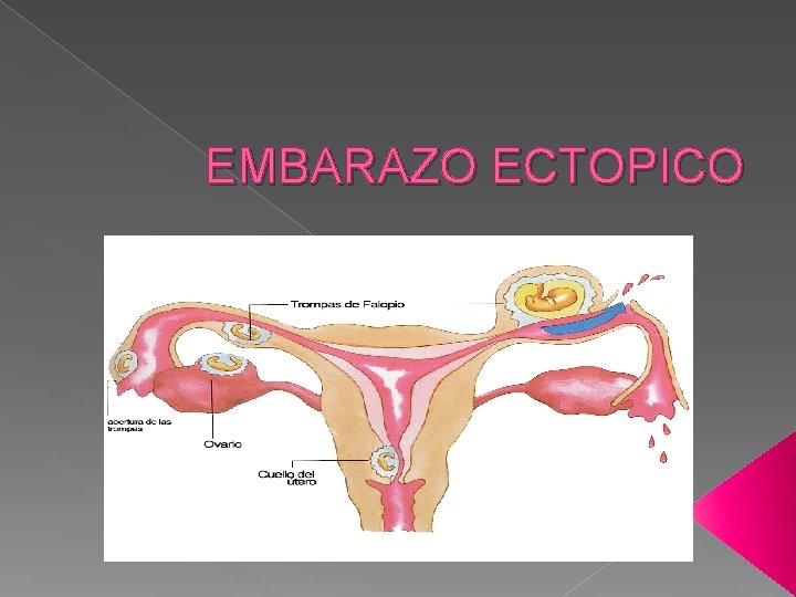 EMBARAZO ECTOPICO 