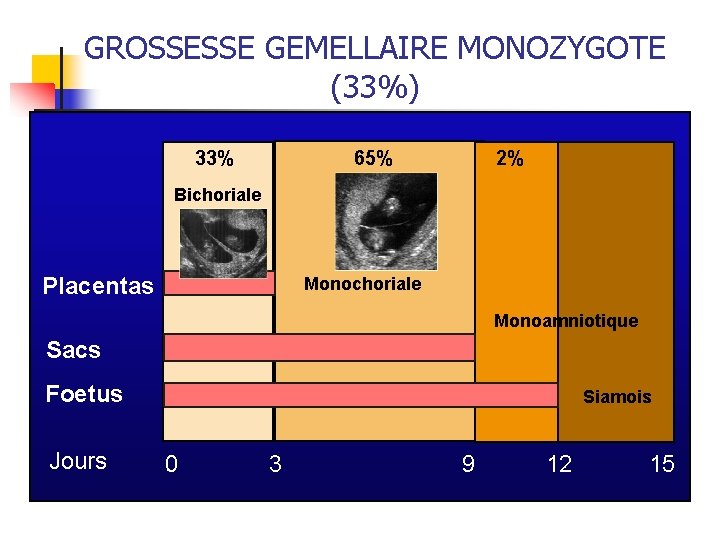 GROSSESSE GEMELLAIRE MONOZYGOTE (33%) 33% 65% 2% Bichoriale Placentas Monochoriale Monoamniotique Sacs Foetus Jours