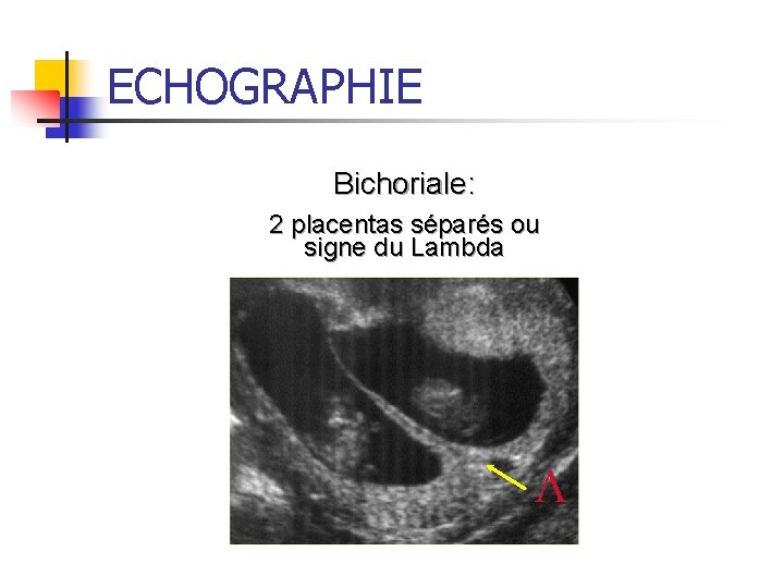 ECHOGRAPHIE Bichoriale: 2 placentas séparés ou signe du Lambda L 