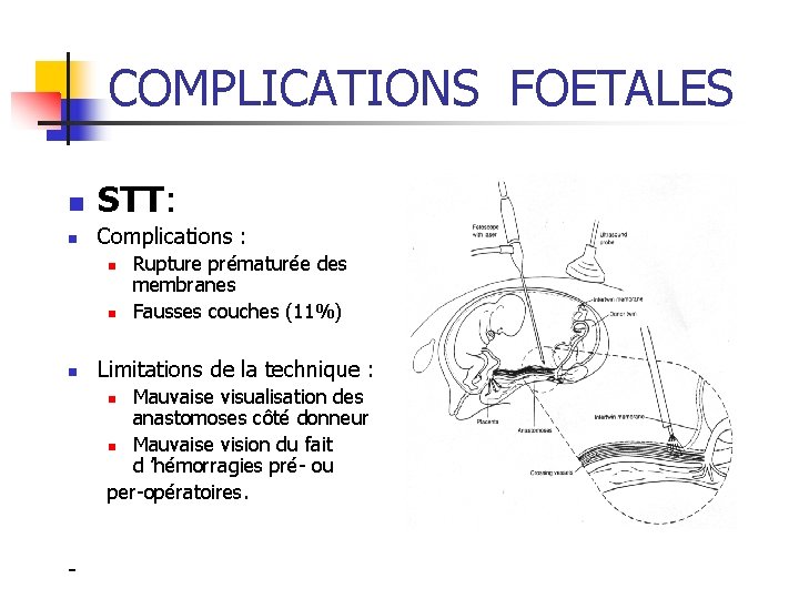 COMPLICATIONS FOETALES n STT: n Complications : n n n Rupture prématurée des membranes
