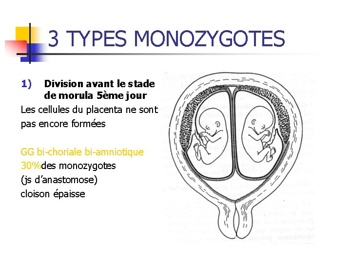 3 TYPES MONOZYGOTES 1) Division avant le stade de morula 5ème jour Les cellules