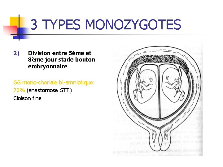 3 TYPES MONOZYGOTES 2) Division entre 5ème et 8ème jour stade bouton embryonnaire GG