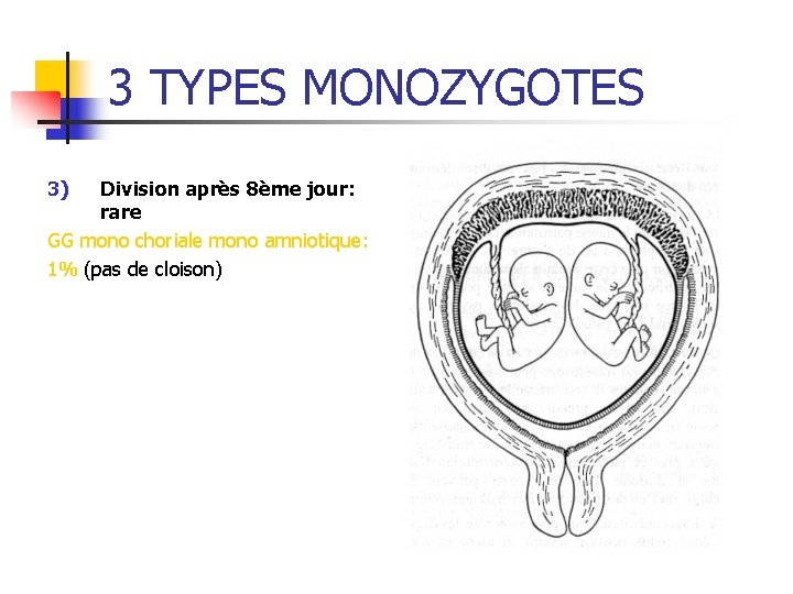 3 TYPES MONOZYGOTES 3) Division après 8ème jour: rare GG mono choriale mono amniotique: