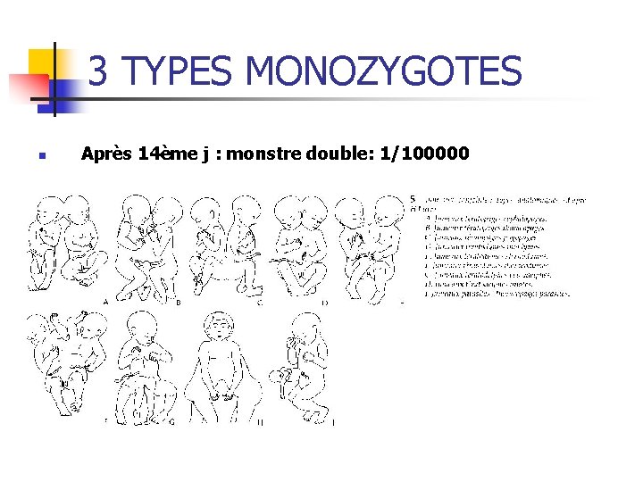 3 TYPES MONOZYGOTES n Après 14ème j : monstre double: 1/100000 