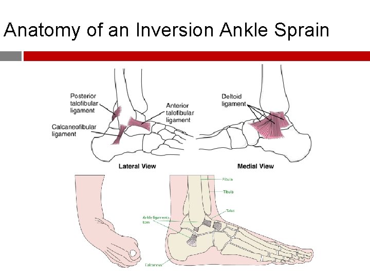 Anatomy of an Inversion Ankle Sprain 