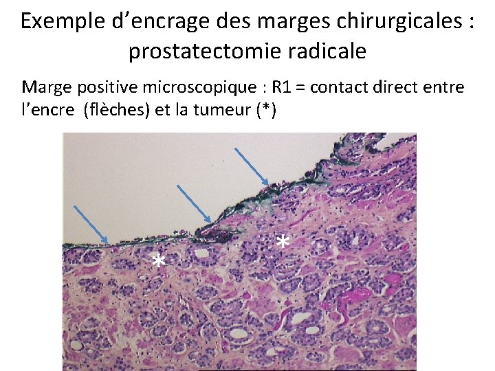 Exemple d’encrage des marges chirurgicales : prostatectomie radicale Marge positive microscopique : R 1 Exemple d’encrage des marges chirurgicales : prostatectomie radicale Marge positive microscopique : R 1