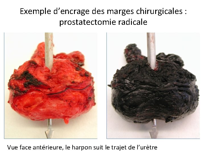 Exemple d’encrage des marges chirurgicales : prostatectomie radicale Vue face antérieure, le harpon suit Exemple d’encrage des marges chirurgicales : prostatectomie radicale Vue face antérieure, le harpon suit
