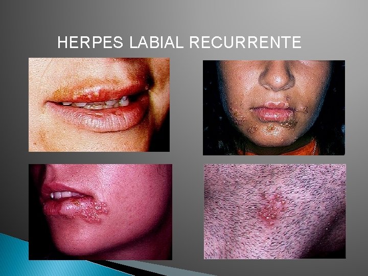 HERPES LABIAL RECURRENTE 