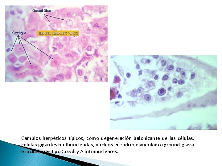 Cambios herpéticos típicos, como degeneración balonizante de las células, células gigantes multinucleadas, núcleos en