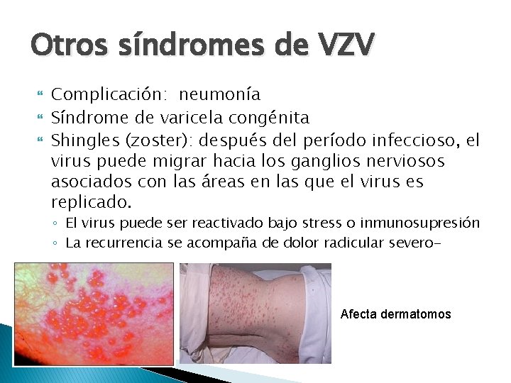 Otros síndromes de VZV Complicación: neumonía Síndrome de varicela congénita Shingles (zoster): después del