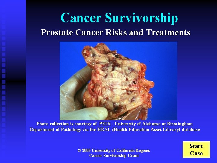 Cancer Survivorship Prostate Cancer Risks and Treatments Photo collection is courtesy of PEIR -