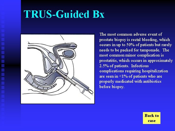 TRUS-Guided Bx The most common adverse event of prostate biopsy is rectal bleeding, which