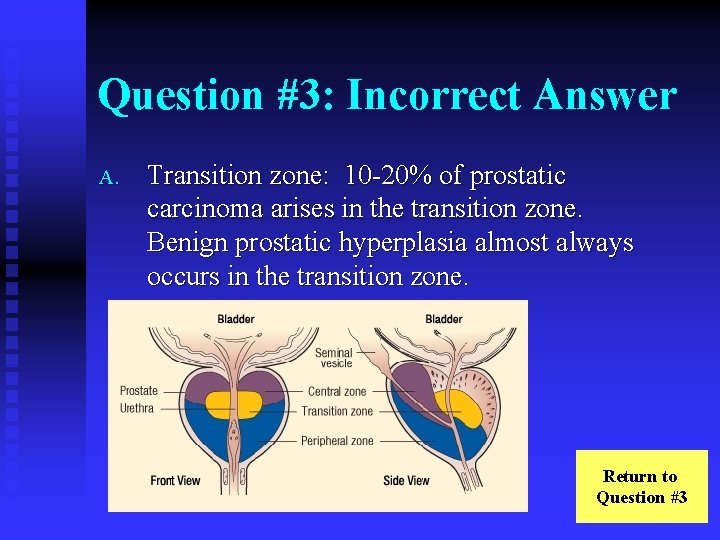 Question #3: Incorrect Answer A. Transition zone: 10 -20% of prostatic carcinoma arises in