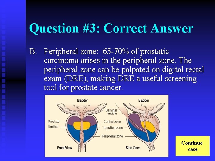 Question #3: Correct Answer B. Peripheral zone: 65 -70% of prostatic carcinoma arises in