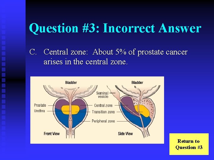 Question #3: Incorrect Answer C. Central zone: About 5% of prostate cancer arises in