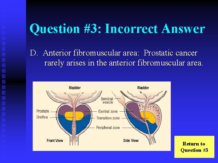 Question #3: Incorrect Answer D. Anterior fibromuscular area: Prostatic cancer rarely arises in the
