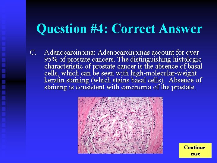 Question #4: Correct Answer C. Adenocarcinoma: Adenocarcinomas account for over 95% of prostate cancers.