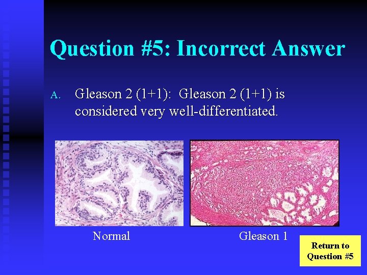 Question #5: Incorrect Answer A. Gleason 2 (1+1): Gleason 2 (1+1) is considered very