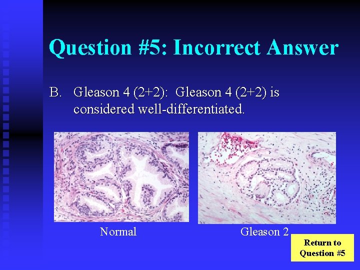 Question #5: Incorrect Answer B. Gleason 4 (2+2): Gleason 4 (2+2) is considered well-differentiated.