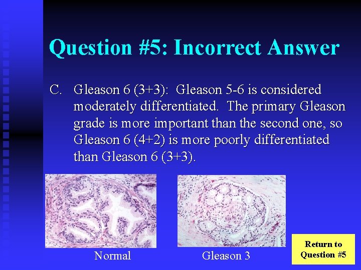 Question #5: Incorrect Answer C. Gleason 6 (3+3): Gleason 5 -6 is considered moderately